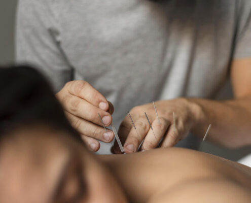 acupuncteur lors d'un traitement d'acupuncture dans le haut du dos