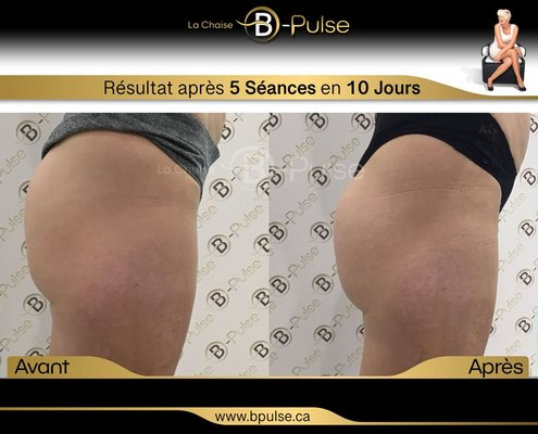 R&eacute;sultat avant / apr&egrave;s de la tonification des fessiers avec la chaise B-Pulse