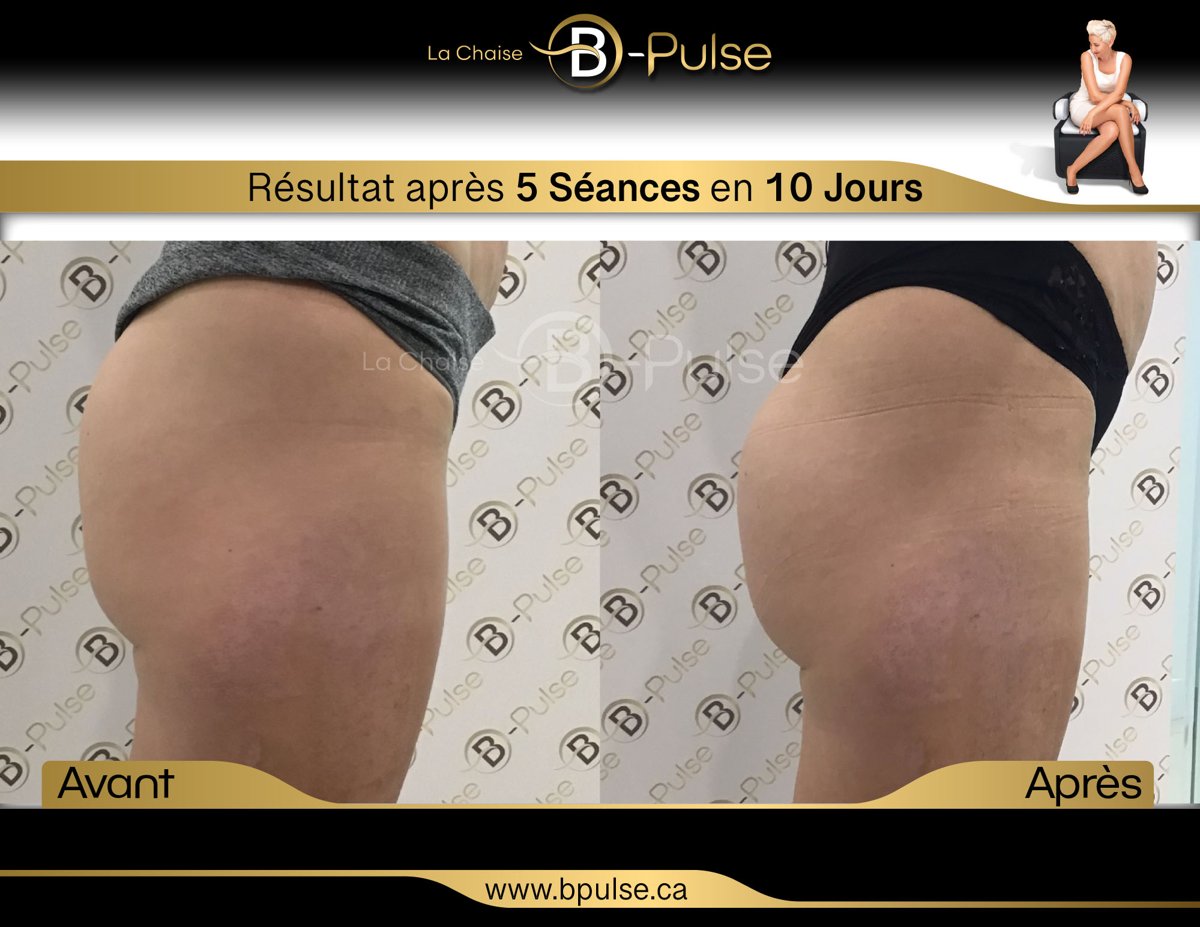Effet lifting des fessiers avec la technologie B-Pulse. Résultat avant / après de la tonification des fessiers avec la chaise B-Pulse - Clinique Synergek