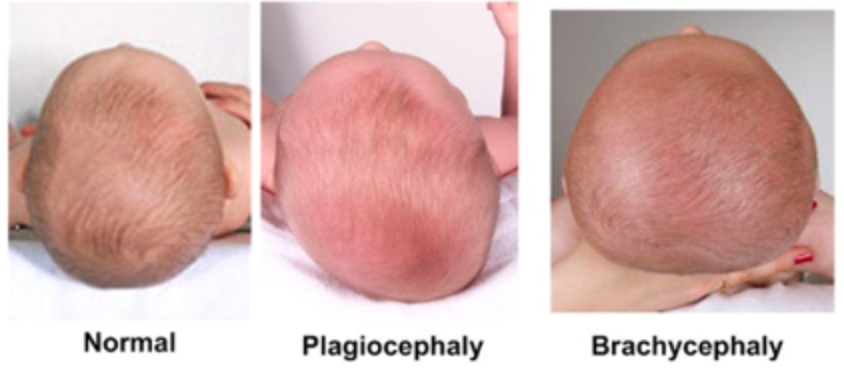 Plagioc phalie Et Rachyc phalie Traitement En Ost opathie